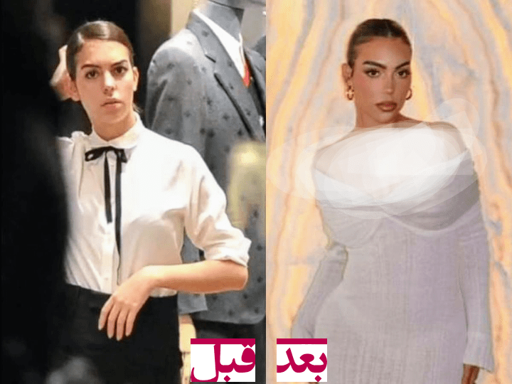 جورجینا رودریگز قبل و بعد عمل